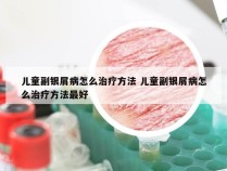 儿童副银屑病怎么治疗方法 儿童副银屑病怎么治疗方法最好