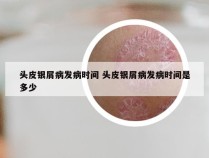 头皮银屑病发病时间 头皮银屑病发病时间是多少