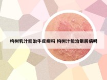 构树乳汁能治牛皮癣吗 构树汁能治银屑病吗