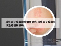 转移因子胶囊治疗银屑病吗 转移因子胶囊可以治疗银屑病吗