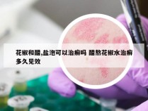 花椒和醋,盐泡可以治癣吗 醋熬花椒水治癣多久见效