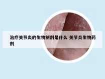 治疗关节炎的生物制剂是什么 关节炎生物药剂