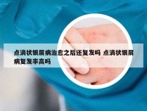 点滴状银屑病治愈之后还复发吗 点滴状银屑病复发率高吗