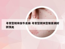 寻常型班块妆牛皮癣 寻常型斑块型银屑病好转预兆