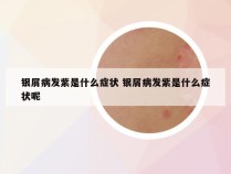 银屑病发紫是什么症状 银屑病发紫是什么症状呢