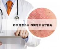 白斑是怎么治 白斑怎么治才能好