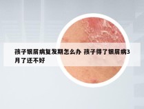 孩子银屑病复发期怎么办 孩子得了银屑病3月了还不好