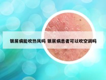 银屑病能吹热风吗 银屑病患者可以吹空调吗