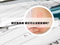 碘伏银屑病 碘伏可以涂银屑病吗?