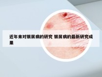 近年来对银屑病的研究 银屑病的最新研究成果