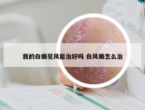 我的白癜见风能治好吗 白风癜怎么治