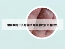 银屑病吃什么比较好 银屑病吃什么有好处