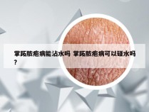 掌跖脓疱病能沾水吗 掌跖脓疱病可以碰水吗?