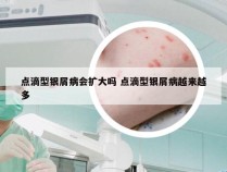 点滴型银屑病会扩大吗 点滴型银屑病越来越多