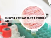 脸上长牛皮屑擦什么药 脸上有牛皮屑用什么药膏