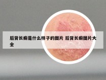 后背长癣是什么样子的图片 后背长癣图片大全