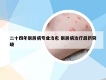 二十四年银屑病专业治愈 银屑病治疗最新突破