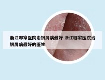 浙江哪家医院治银屑病最好 浙江哪家医院治银屑病最好的医生