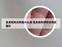 色素脱失白斑是什么病 色素脱失斑和白斑区图片