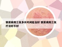 银屑癣用三氧多长时间能治好 银屑病用三氧疗法好不好