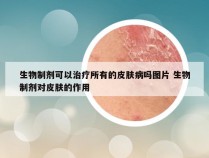 生物制剂可以治疗所有的皮肤病吗图片 生物制剂对皮肤的作用