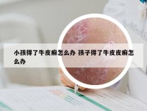 小孩得了牛皮癣怎么办 孩子得了牛皮皮癣怎么办