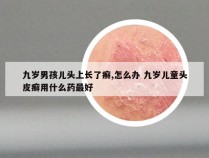 九岁男孩儿头上长了癣,怎么办 九岁儿童头皮癣用什么药最好