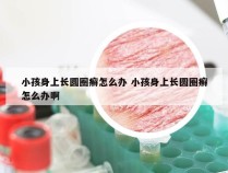 小孩身上长圆圈癣怎么办 小孩身上长圆圈癣怎么办啊