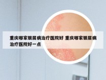 重庆哪家银屑病治疗医院好 重庆哪家银屑病治疗医院好一点