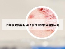 白斑病会传染吗 身上有白斑会传染给别人吗