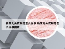 新生儿头皮癣是怎么回事 新生儿头皮癣是怎么回事图片