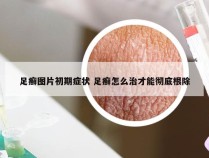 足癣图片初期症状 足癣怎么治才能彻底根除