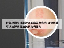 针灸埋线可以治好银屑病关节炎吗 针灸埋线可以治好银屑病关节炎吗图片