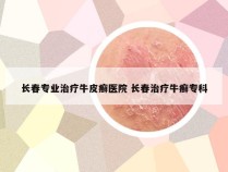 长春专业治疗牛皮癣医院 长春治疗牛癣专科