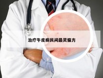 治疗牛皮癣民间最灵偏方