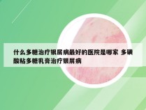 什么多糖治疗银屑病最好的医院是哪家 多磺酸粘多糖乳膏治疗银屑病