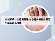 小腿长癣什么原因引起的 小腿长癣什么原因引起的怎么治疗