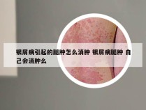 银屑病引起的腿肿怎么消肿 银屑病腿肿 自己会消肿么