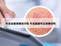 牛皮皮癣用碘伏行吗 牛皮肤癣可以用碘伏吗