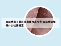 银屑病是不是必须发作再去检查 银屑病需要做什么检查确定