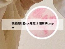 银屑病引起scc升高17 银屑病caspar