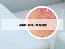 分类癣 癣的分类与症状