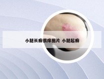 小腿长癣很痒图片 小腿起癣