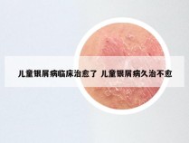 儿童银屑病临床治愈了 儿童银屑病久治不愈