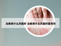 治癣用什么药最好 治癣用什么药最好最有效