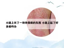 小腿上长了一块块像癣的东西 小腿上起了好多癣咋办