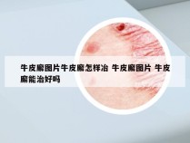 牛皮廨图片牛皮廨怎样冶 牛皮廨图片 牛皮廨能治好吗