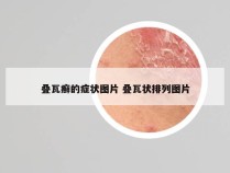 叠瓦癣的症状图片 叠瓦状排列图片