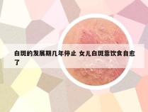 白斑的发展期几年停止 女儿白斑靠饮食自愈了