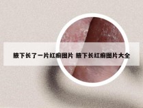 腋下长了一片红癣图片 腋下长红癣图片大全